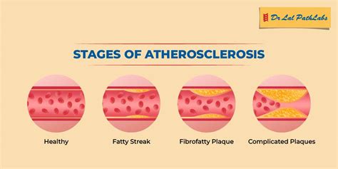 positive for atherosclerosis symptoms